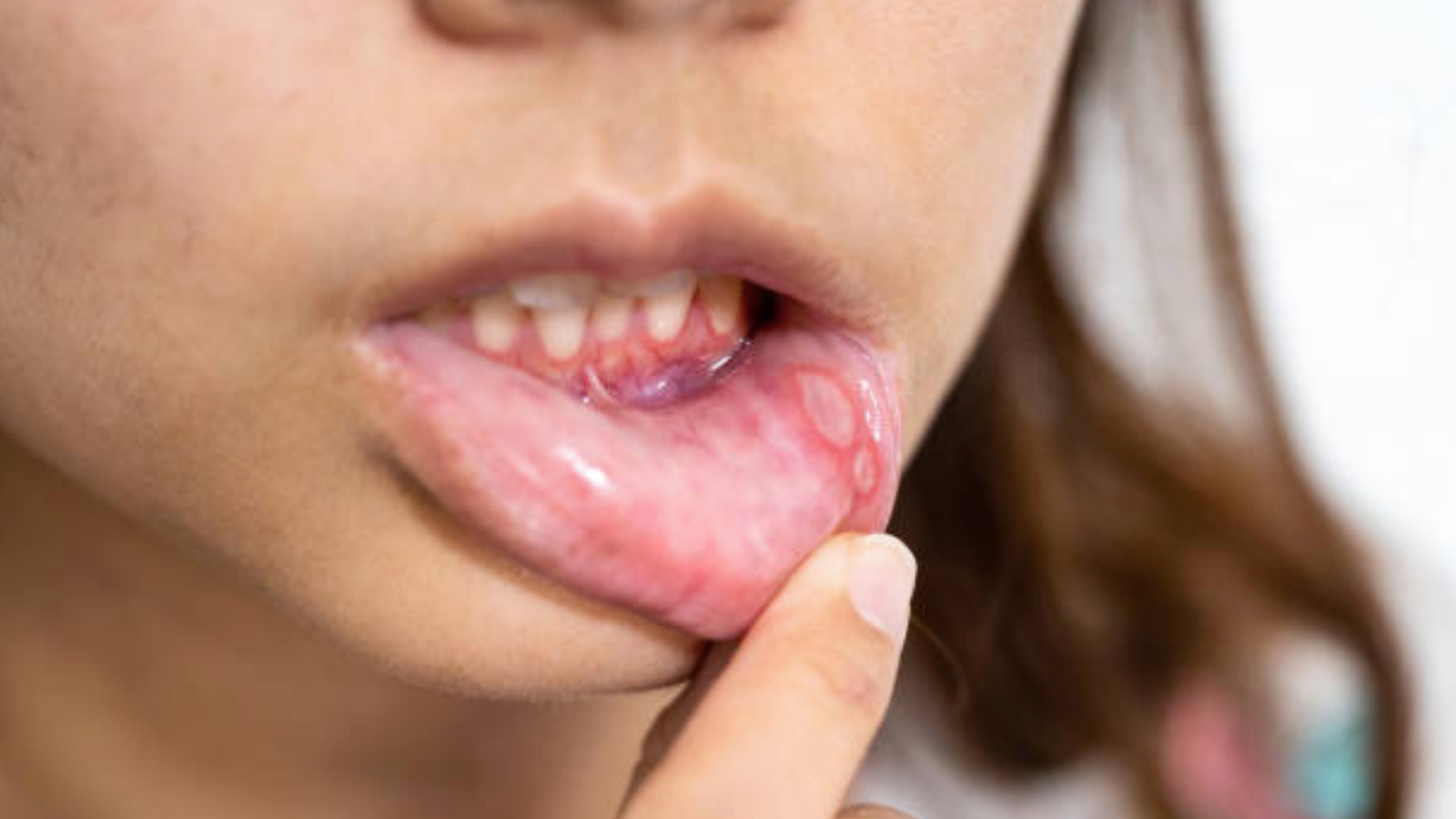 uzmani uyardi 2 haftadan uzun suren agiz yaralari ihmal edilmemeli MIBZzuDs